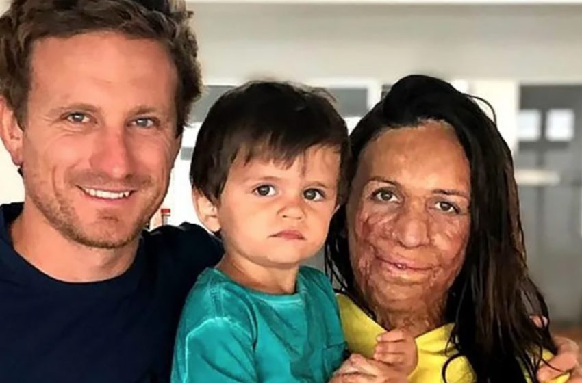  After a fire damaged his wife’s beauty, the husband refuses to leave her