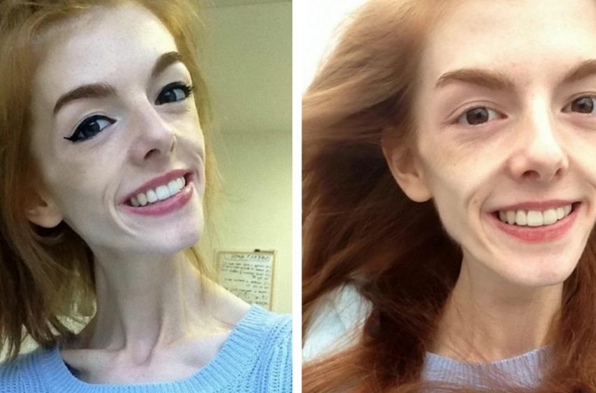  Two years ago she weighed only 64 Ibs, but an ordinary chocolate helped her cure her anorexia