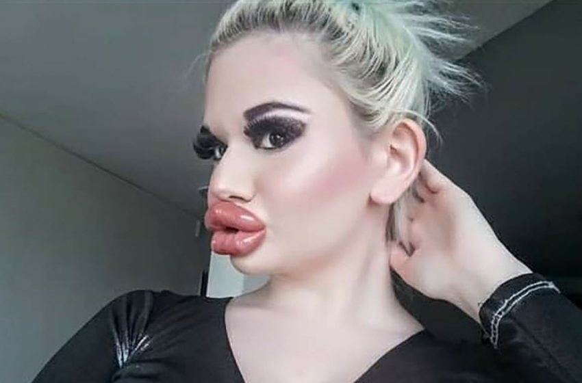  The girl with the biggest lips in the world enlarged them for the 27th time and showed the result