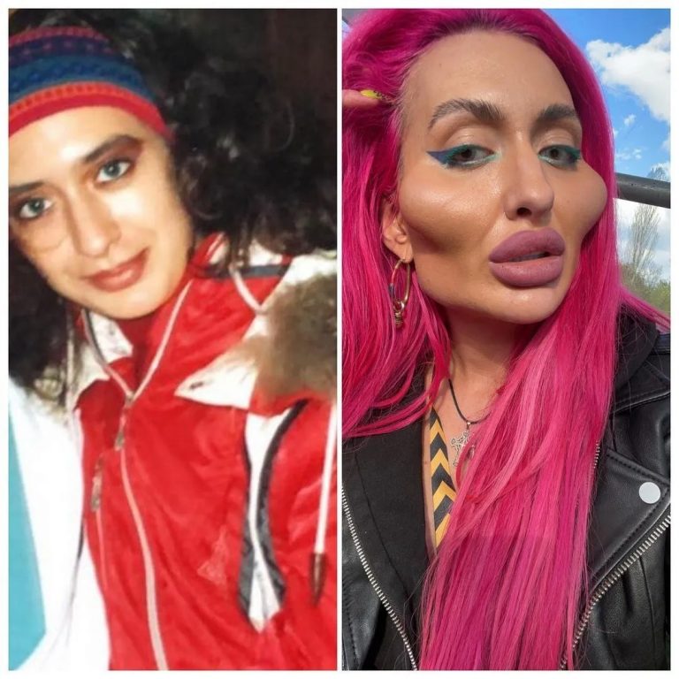 "Antes de la cirugía plástica" una mujer con los pómulos más grandes