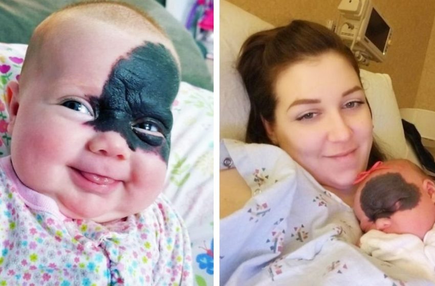  How Does the “Baby Batman” From the U.S., Who was Born with a Birthmark on Her Face, Look Like Now?