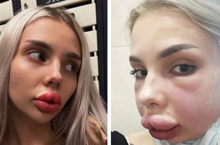 Lips Halfway Up Her Face: Girl Almost Died After Facial