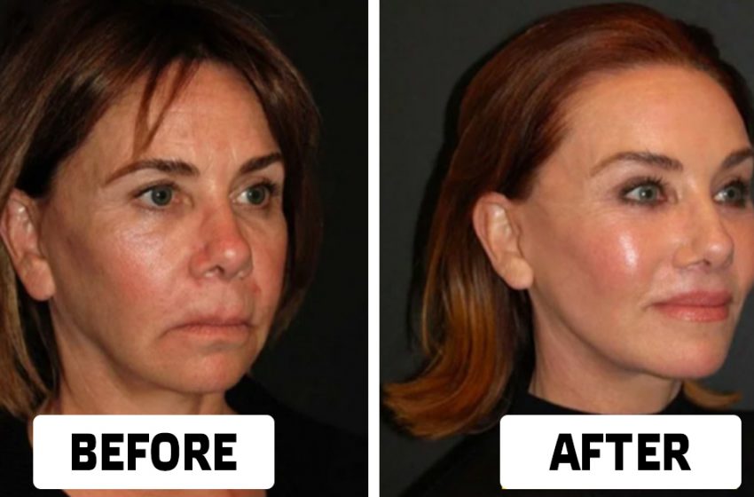  Photos of Ordinary Women Transformed After a Facelift