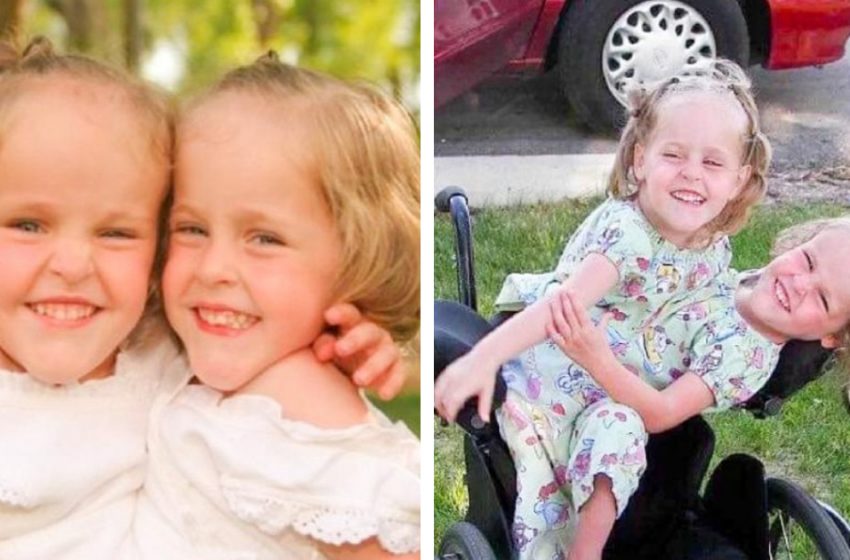  These Siamese Twins were Separated when They were 4 Years old: How are They Doing Now?