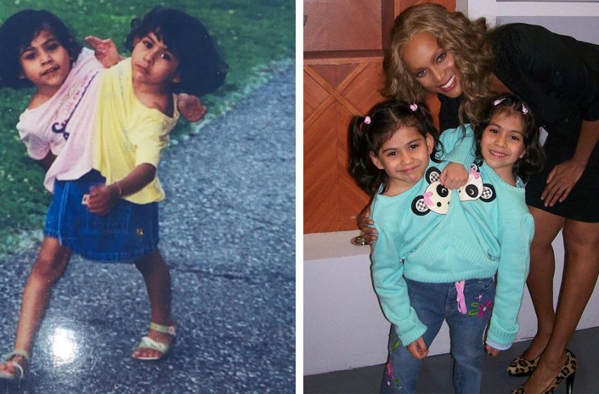  Doctors Predicted the Siamese Twins to Live Up to 3 Days and They have Already Celebrated Their 18th Birthday