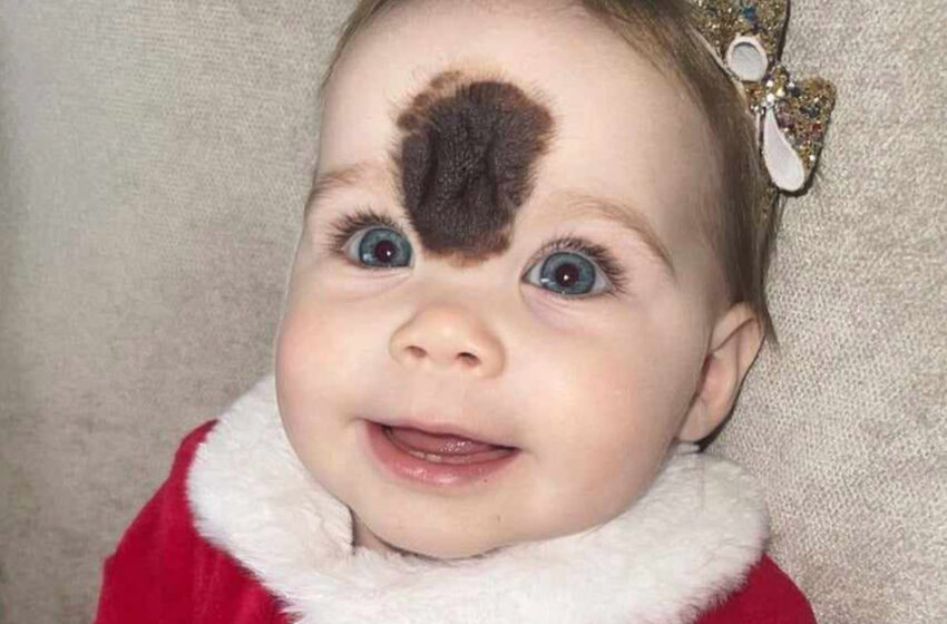  “Adorable Beauty”: The Mother Of a Girl With a Birthmark Showed Off Her Daughter After Surgery!