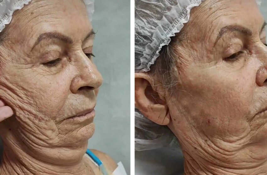  “She Is Unrecognizable After Plastic Surgery”: An Old Lady Turned Into a Young Beauty!