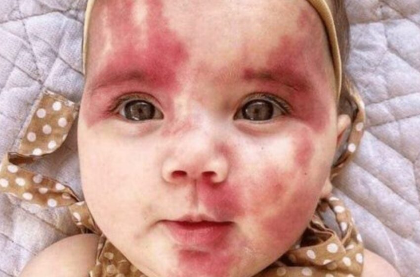  The Baby Born With a Heart-Shaped Wine Stain On Her Face: What Does She Look Like Now?