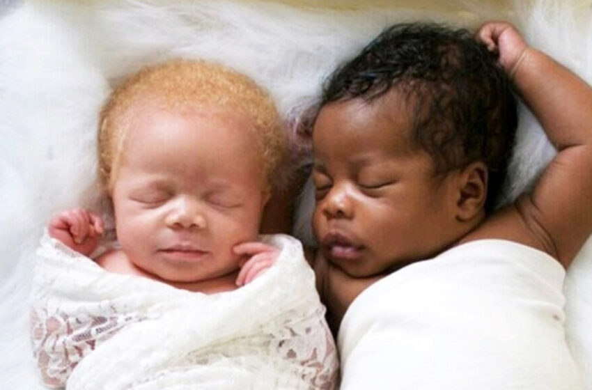  “They are Very Different, But Are So The Same”: What Do The Twins One Of Whom Was Born an Albino Look Like Now?
