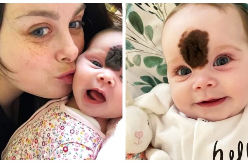  The Baby Was Born With a Big Birthmark On Her Face: She Was Operated On And Looks Awesome After Surgery!