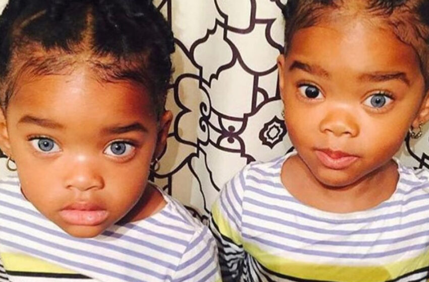  “Magic Eyes”: What Do The Grown-up Twin Sisters Who Were Born With a Rare Genetic Feature Look Like Now?