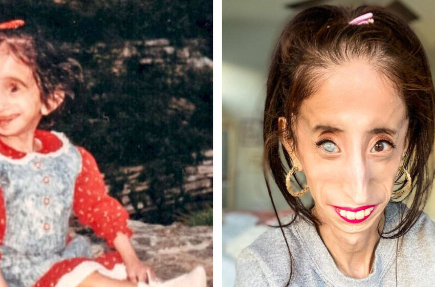  “A Woman With a Cruel Fate”: What Does The Girl Who Was Called “The Ugliest In The World” Look Like Now?