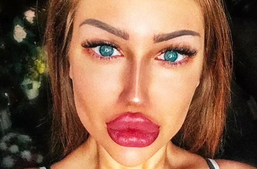  “She Was a Sweet Girl Before Plastic”: The Girl Spoilt Her Appearance With Plastic Surgeries!