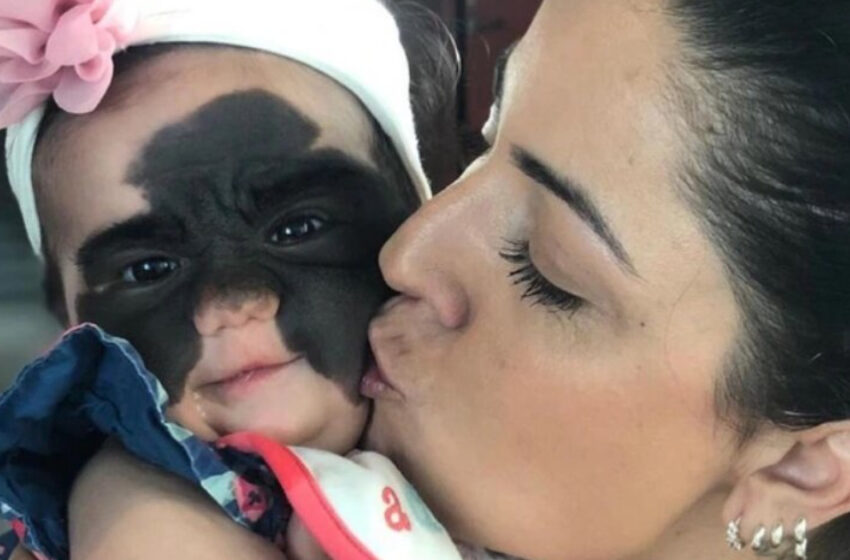  The Little Girl Was Called “Ugly Duckling” Because Of Her Birthmark: What Does She Look Like After Surgery?