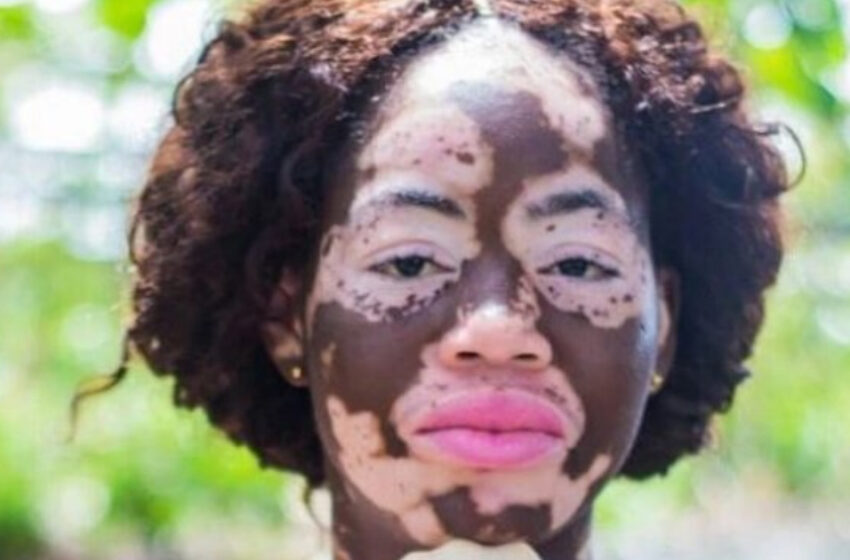  “People Thought She Was Doused With Acid”: A Unique Girl With Vitiligo Who Wins The World Shared Her Full Height Photos!!