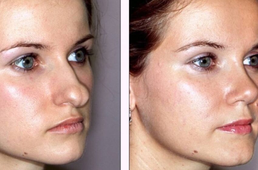  Positive Side Of Plastic Surgery: Photos Of Girls Who Underwent Plastic To Enhance Their Appearance!
