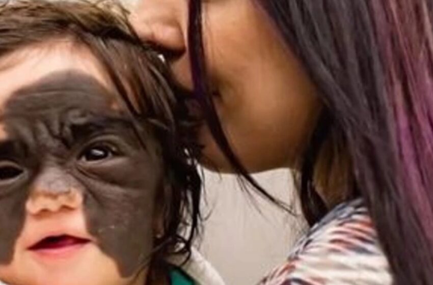  A Girl Born With A Big Dark Birthmark On Her Face Was Mocked And Called A “Monster”: What Does She Look Like After Surgery That Treated Her Birthmark?