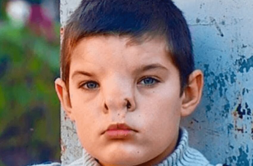  A Boy Born With a Rare Nose Condition Underwent Surgery: What Does He Look Like Now?