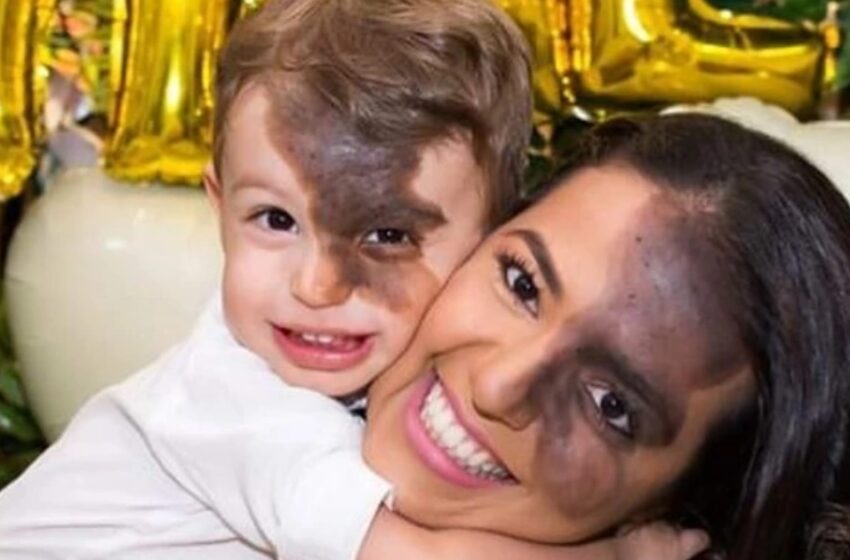  “I Didn’t Want My Son To Feel Different”: A Mom Got a Replica Of Her Son’s Dark Birthmark So That The Boy Didn’t Feel Ashamed Of His Face!