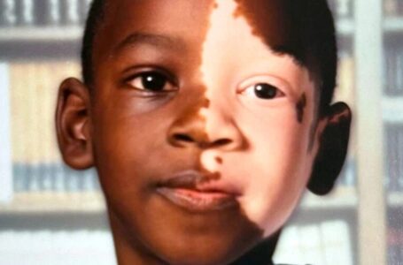 The Boy Born With A Big Pigmentation Spot On His Face Was Ashamed Of His Appearance: Due To His Mother’s Support And Advice He Managed To Become Famous All Over The Country!