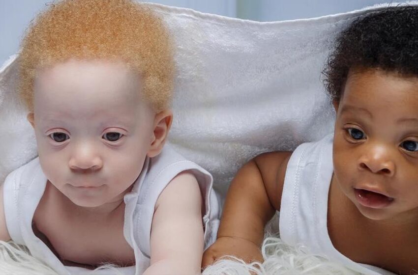  “Their Birth Was a Big Surprise For Everyone”: What Do Twin Brothers With Different Skin Colors Look Like Now?