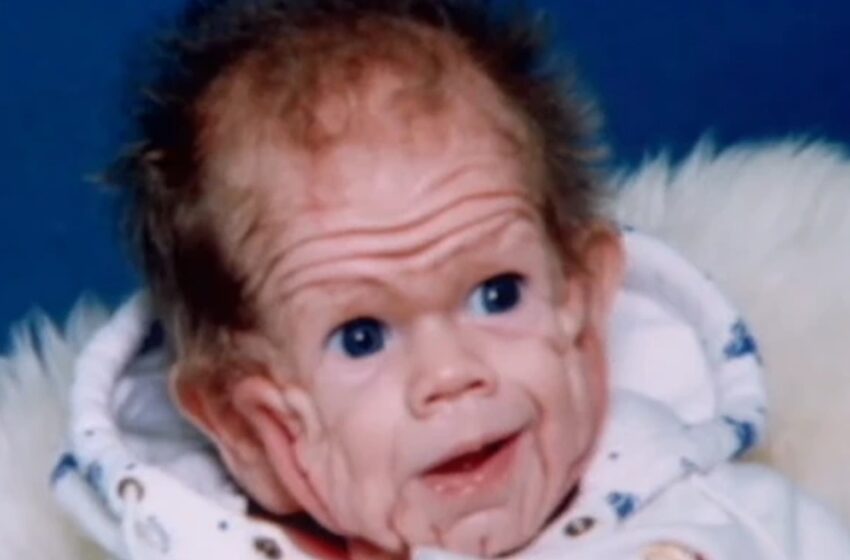  “The Baby Who Stunned Doctors With His Rare Disorder”: What Does The Kid Look Like Now – 20 Years Later?