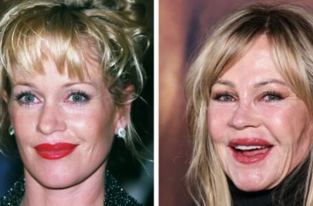 “When Expectations Don’t Meet Reality”: 13 Shocking Before and After Photos Of Celebrities Who Underwent Cosmetic Surgeries!