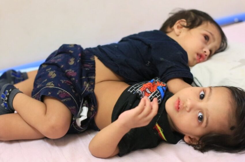  “They Had One Liver, One Bladder And One Stomach For Two”: Photos Of The Siamese Twins From India After Surgery!