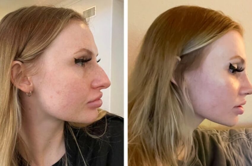  They Had Complexes And Low Self-Esteem: 18 Amazing Transformations Of People Who Had Plastic Surgery And Are Delighted With The Result!