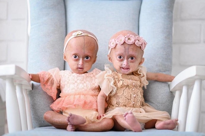 À Quoi Ressemblent Maintenant Les Jumeaux Nés Avec Le Rare Syndrome De Benjamin Button 😱 