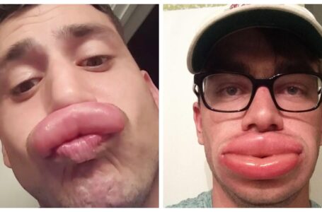 “Bee Stings Instead Of Botox”: 11 Hilarious Shots Of Bees Helping People With “Duck Lips”!