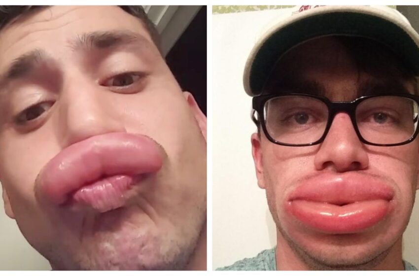  “Bee Stings Instead Of Botox”: 11 Hilarious Shots Of Bees Helping People With “Duck Lips”!