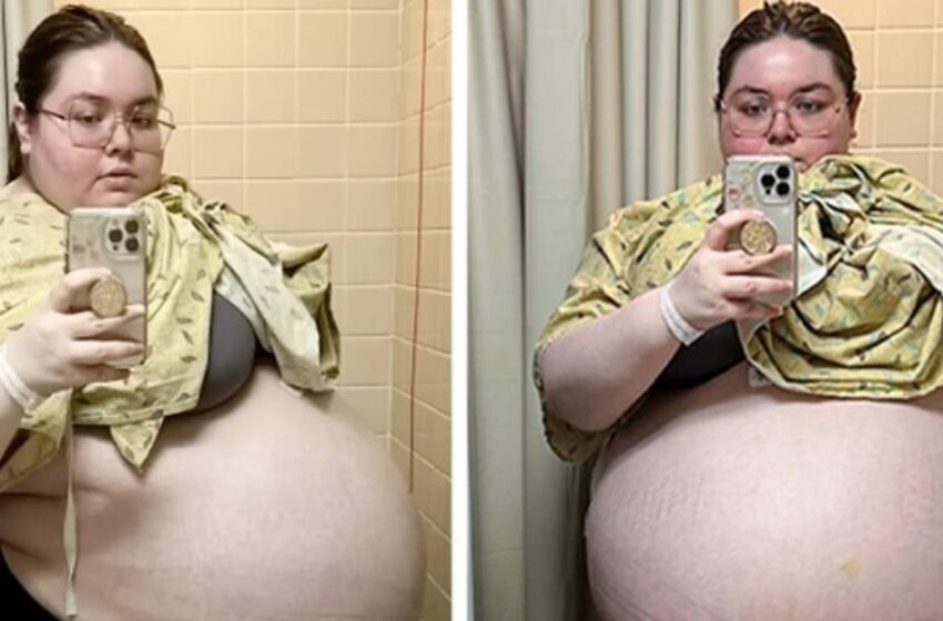  Doctors Advised Her To Lose Weight: Everyone Was Shocked When a 104-Pound Tumor Was Discovered Inside Her!