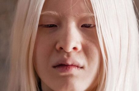 “A Radical Transformation”: A Girl With Albinism Decided To Become a Brunette!