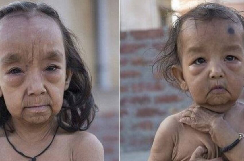  “Brother And Sister From India Look Like “Little Old People”: The Dreadful Story Of The Siblings!