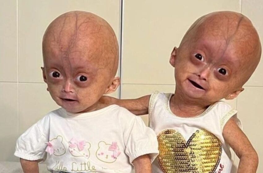 “Dvīņi, dzimuši ar retu Benjamina Batona sindromu”: kā izskatās māsas?