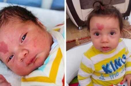 Ein Baby, das mit einem herzförmigen Muttermal auf der Stirn geboren wurde. Wie sieht es mit 6 Jahren aus?