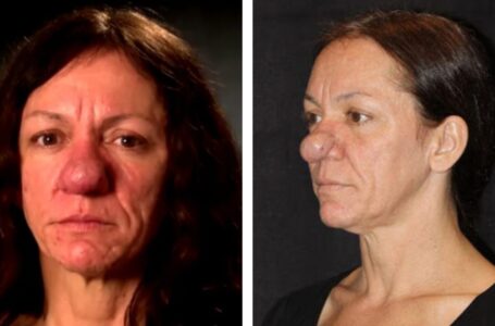 „Ji tapo tikra gražuole“: moteris, gimusi su didelę nosį dėl retos ligos, nusprendė pasidaryti plastinę operaciją!