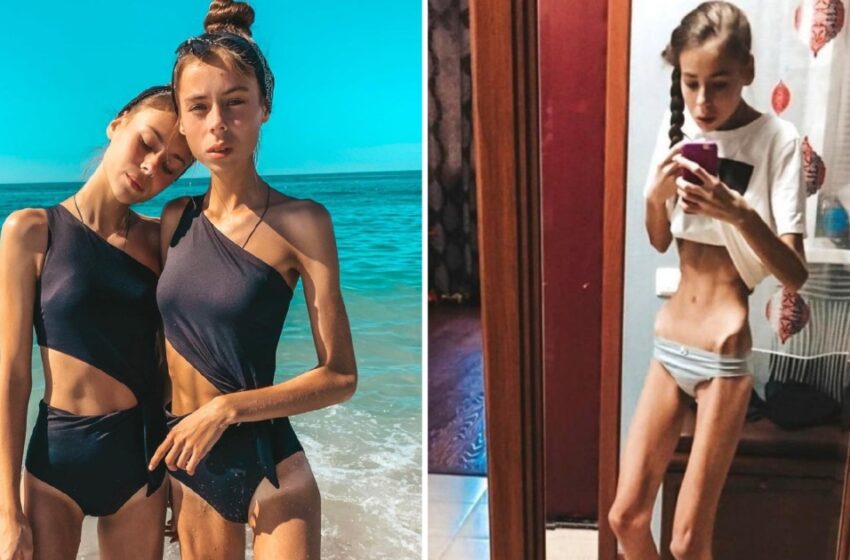  Jų svoris buvo vos 38 kg ir jos beveik mirė, bet jos įveikė iššūkį!: Kaip jos atrodo dabar?