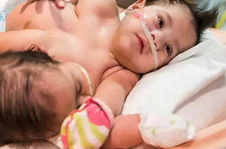 Neįtikėtina dvynių, gimusių sujungtų, istorija, kurios sėkmė pranoko lūkesčius!: Kaip jos atrodo dabar?